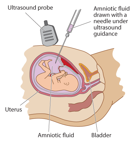 Pregnancy needle clearance test