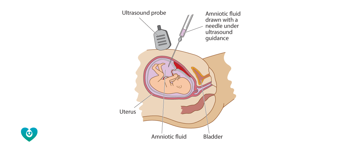 Amniocentesis-R.png#asset:895:url