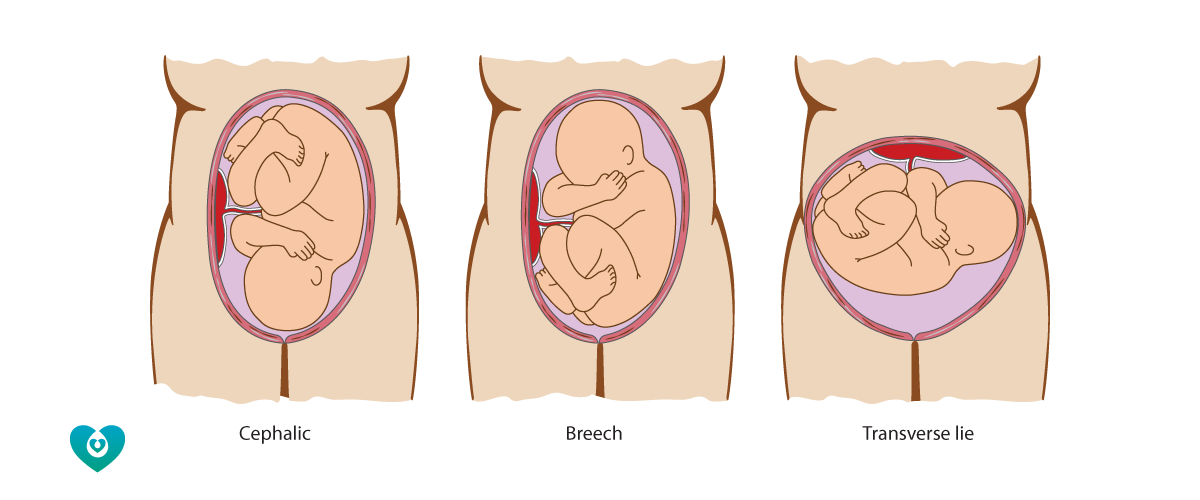Fetal-Presentation-R1.png#asset:902