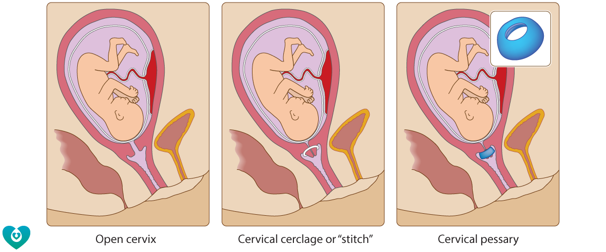 Short cervix